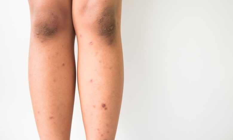 Dark spots on legs: 4 reasons why you have these and how to get rid of them