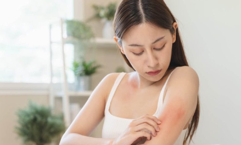 Caterpillar rash can cause skin irritation, know what to do about it