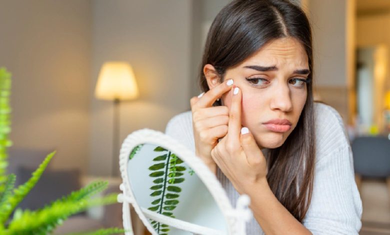 Benzoyl peroxide for acne: Is it an effective treatment for pimples, blackheads?