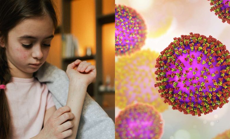 Measles outbreak in USA claims one life: Know symptoms and how to prevent it