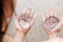 International Alopecia Day 2025: Cosmetic surgeon explains why autoimmune hair loss is rising